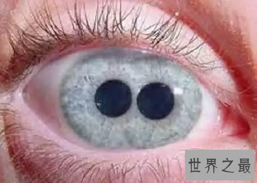【图】双瞳人让人感到恐惧但其实他们和一般人一样