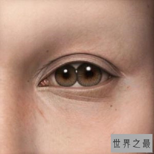 【图】双瞳人让人感到恐惧但其实他们和一般人一样