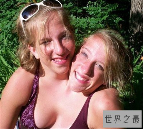 【图】连体婴儿长什么样 曾有连体婴儿胜利做完手术