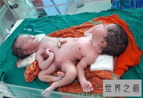 【图】连体婴儿长什么样 曾有连体婴儿胜利做完手术