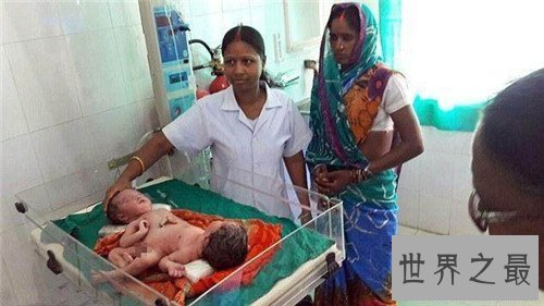 【图】连体婴儿长什么样 曾有连体婴儿胜利做完手术