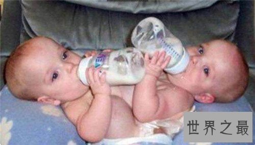 【图】连体婴儿长什么样 曾有连体婴儿胜利做完手术