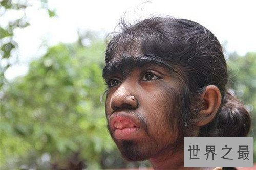 【图】怪病都有哪些呢 曾有女孩皮肤始终长金属丝