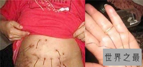 【图】怪病都有哪些呢 曾有女孩皮肤始终长金属丝