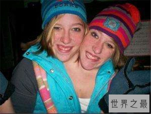 【图】阿比盖尔和布列塔妮系双头美女 她们示意不能嫁