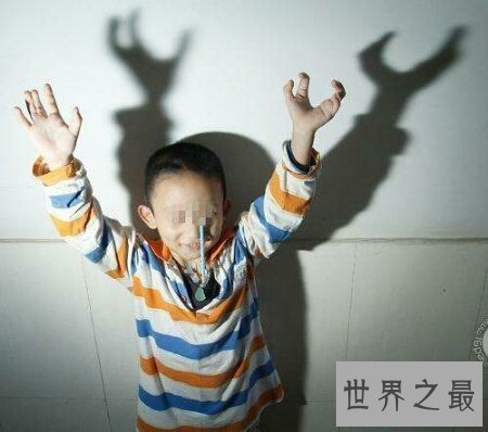 【图】宝宝出生时为螃蟹手怎样去治疗 可能治疗好吗