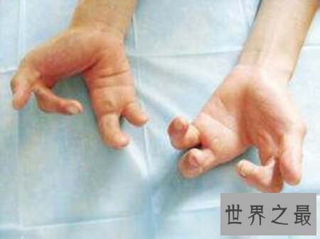 【图】宝宝出生时为螃蟹手怎样去治疗 可能治疗好吗