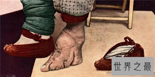 【图】缠足图片畸形吓人 缠足对女性损伤有多大