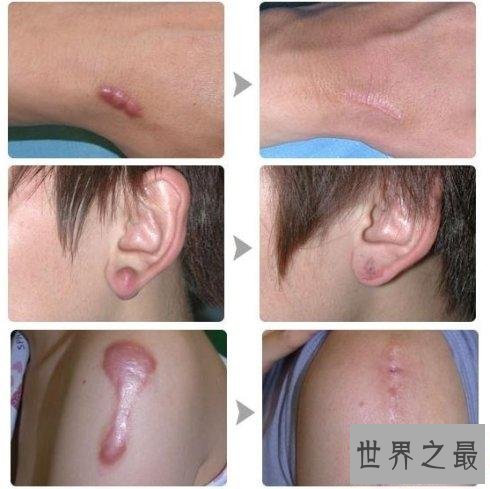 【图】年轻时留下的疤痕让人超级悔恨 怎么祛疤最有效
