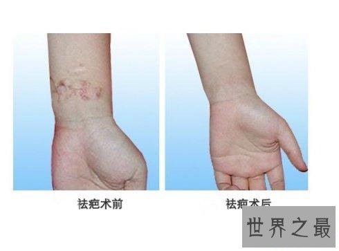 【图】年轻时留下的疤痕让人超级悔恨 怎么祛疤最有效