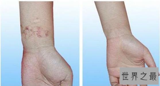 【图】年轻时留下的疤痕让人超级悔恨 怎么祛疤最有效