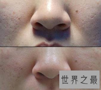 【图】毛孔细小怎样办？ 专家建议帮你有效收缩毛孔