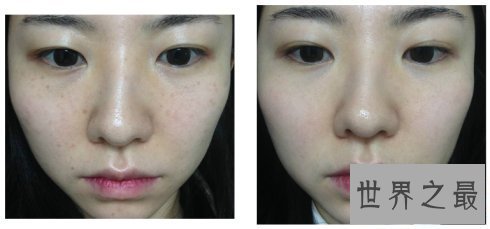 【图】毛孔细小怎样办？ 专家建议帮你有效收缩毛孔