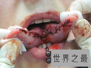 【图】分舌手术对人们百害无一利 但仍然有很多人去做