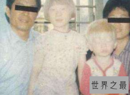 【图】白化病能活多久是很多人心中的纳闷关于白化病