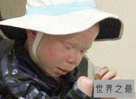 【图】白化病能活多久是很多人心中的纳闷关于白化病