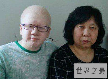 【图】白化病能活多久是很多人心中的纳闷关于白化病