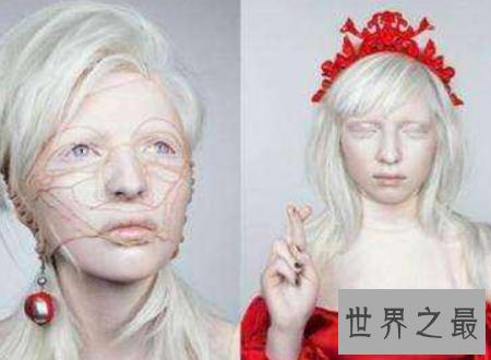 【图】白化病能活多久是很多人心中的纳闷关于白化病