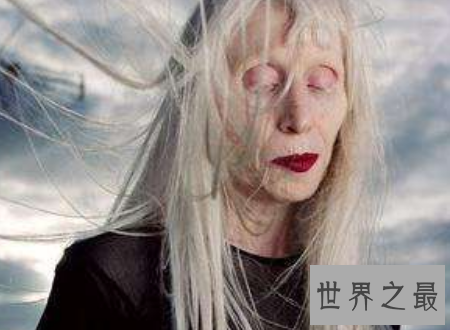 【图】白化病能活多久是很多人心中的纳闷关于白化病