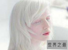 【图】白化病能活多久是很多人心中的疑惑关于白化病