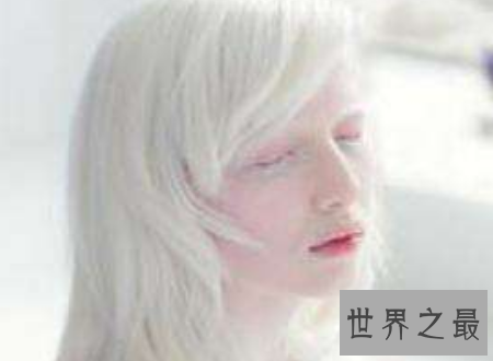 【图】白化病能活多久是很多人心中的纳闷关于白化病