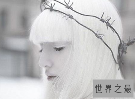 【图】白化病能活多久是很多人心中的纳闷关于白化病