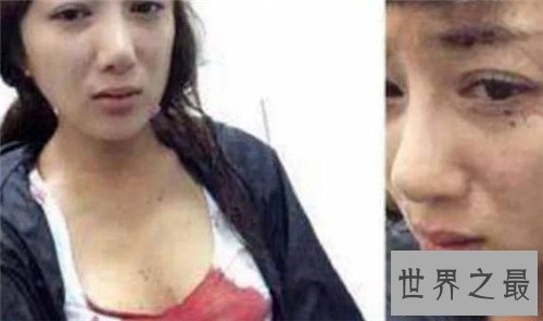 【图】李依晓整容 缘由竟然是被她的狗咬伤