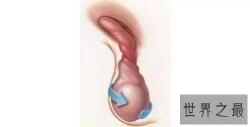 【图】静脉曲张是什么意思，遇到这样的成绩该怎样治