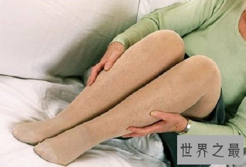 【图】静脉曲张是什么意思，遇到这样的成绩该怎样治