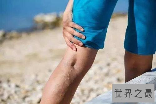 【图】静脉曲张是什么意思，遇到这样的成绩该怎样治