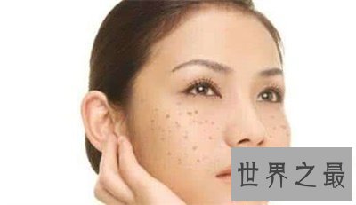 【图】看了黄褐斑图 你还不好好颐养本人的皮肤吗