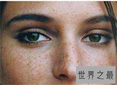 【图】看了黄褐斑图 你还不好好颐养本人的皮肤吗