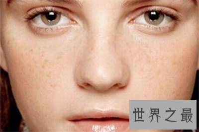 【图】看了黄褐斑图 你还不好好颐养本人的皮肤吗