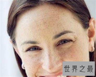 【图】看了黄褐斑图 你还不好好颐养本人的皮肤吗