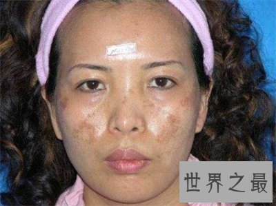 【图】看了黄褐斑图 你还不好好颐养本人的皮肤吗