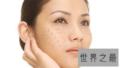 【图】看了黄褐斑图 你还不好好颐养本人的皮肤吗