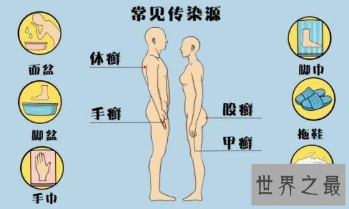 【图】脚气怎样治,水泡型脚气怎样治疗,孕妇得了脚