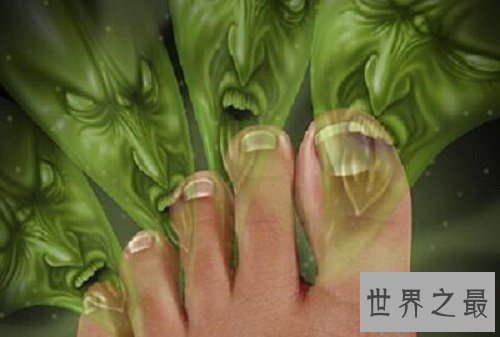 【图】脚气怎样治,水泡型脚气怎样治疗,孕妇得了脚