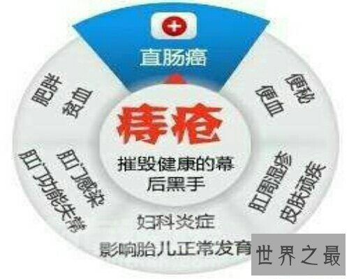 【图】痔疮是一种十分痛苦的疾病 痔疮的症状是什么呢