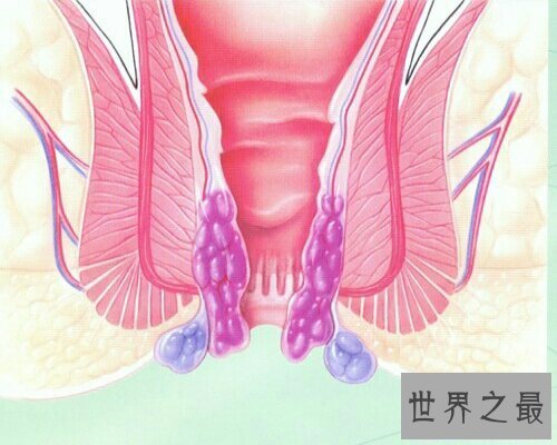 【图】痔疮是一种十分痛苦的疾病 痔疮的症状是什么呢