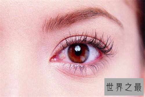 【图】眼睛红血丝是怎样回事 快速消弭红血丝方法