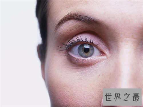 【图】眼睛红血丝是怎样回事 快速消弭红血丝方法