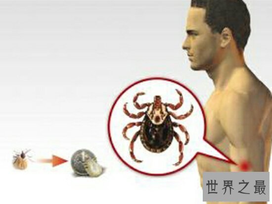 【图】经过蜱虫图片了解这种虫子，钻进人体病菌感染
