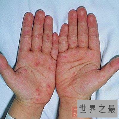 【图】一组皮疹图片带咱们来一同了解意下如何预防治