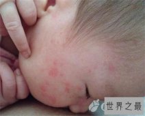 【图】一组皮疹图片带我们来一起了解意下如何预防治