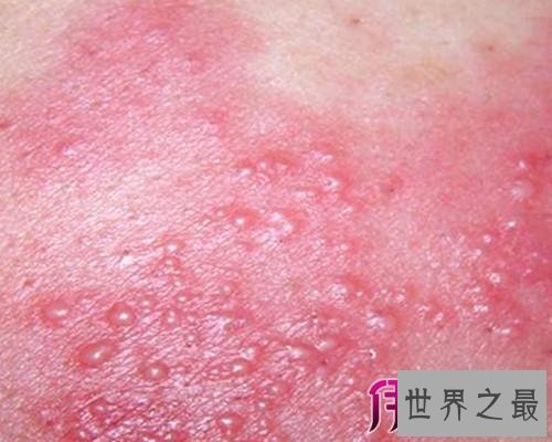 【图】一组皮疹图片带咱们来一同了解意下如何预防治