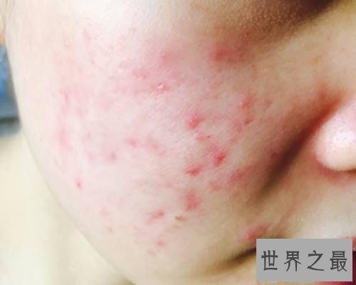 【图】一组皮疹图片带咱们来一同了解意下如何预防治