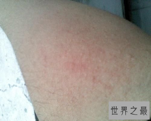 【图】一组皮疹图片带咱们来一同了解意下如何预防治