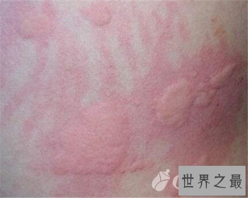 【图】一组皮疹图片带咱们来一同了解意下如何预防治