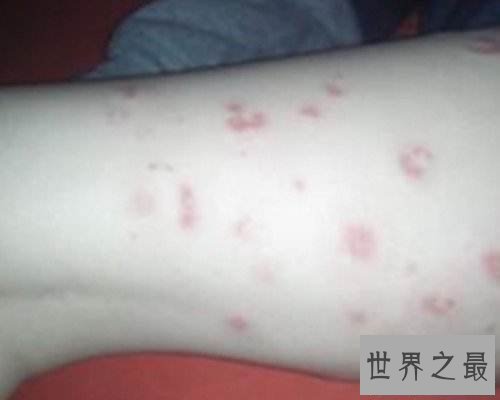 【图】一组皮疹图片带咱们来一同了解意下如何预防治